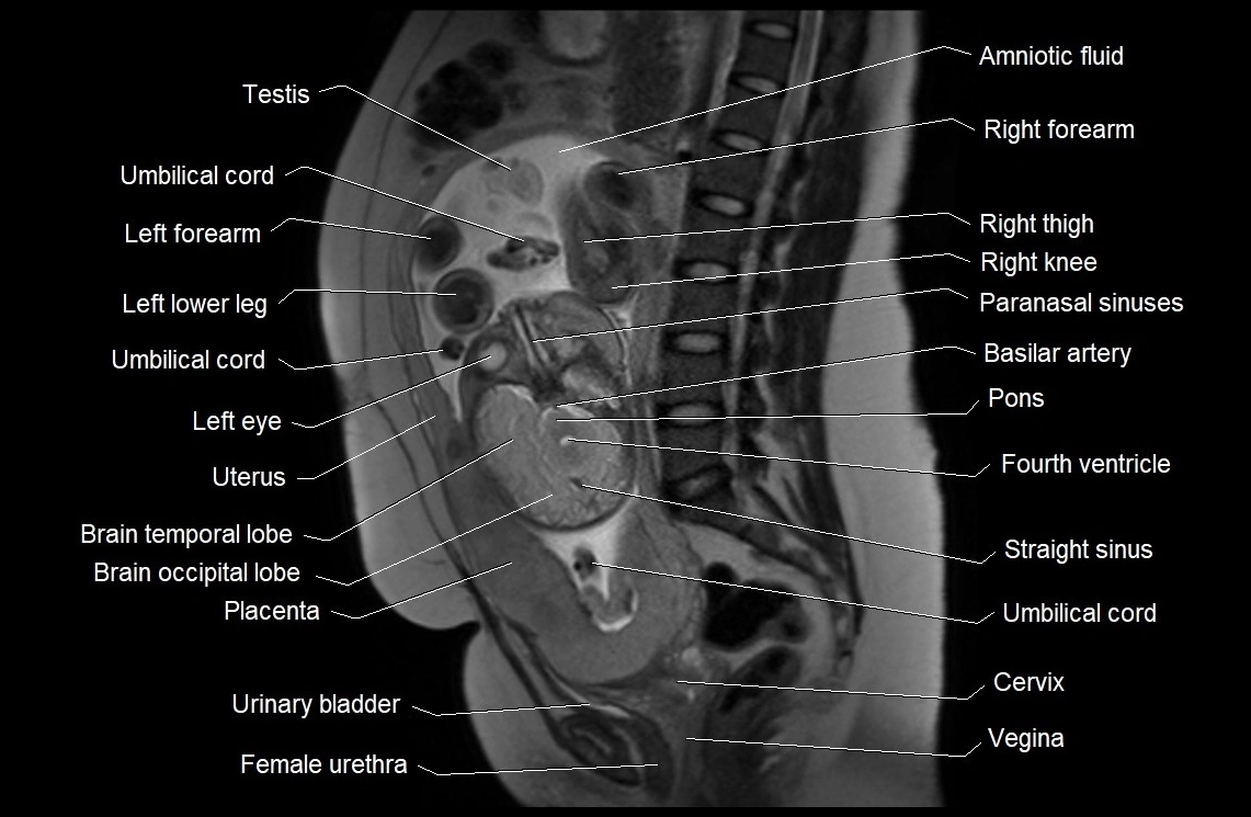 MRI fetal anatomy sagittal image 18.webp